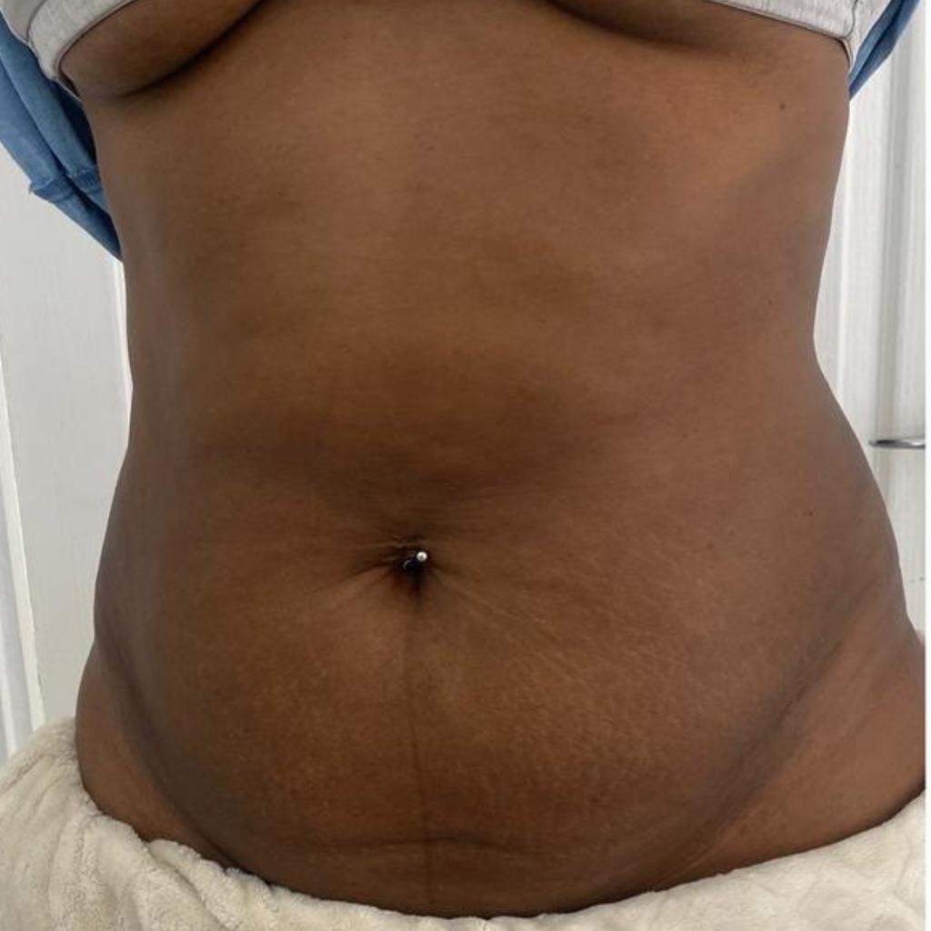 Fat Freeze · Abdomen, after treatment at Saint Aesthetics Clinic in Fourways, Sandton