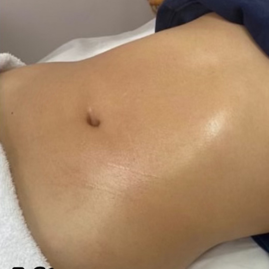 Body Contouring · Abdomen, after treatment at Saint Aesthetics Clinic in Fourways, Sandton
