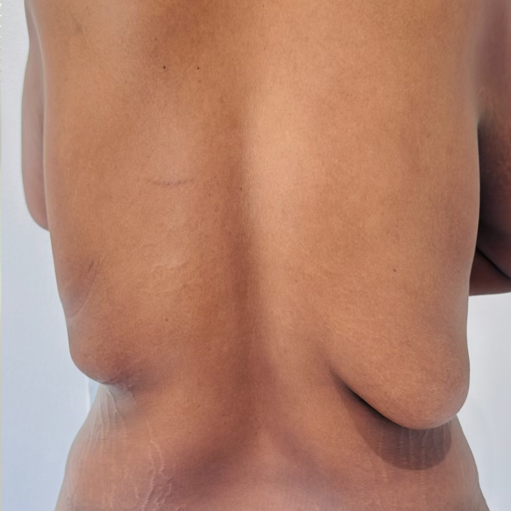 Body Contouring · Back, after treatment at Saint Aesthetics Clinic in Fourways, Sandton