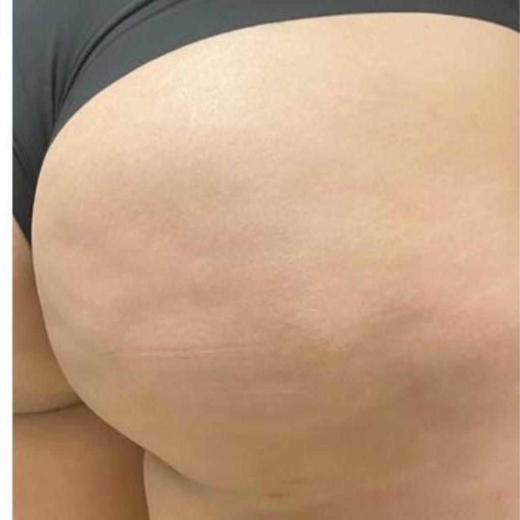Cellulite · Bum, after treatment at Saint Aesthetics Clinic in Fourways, Sandton