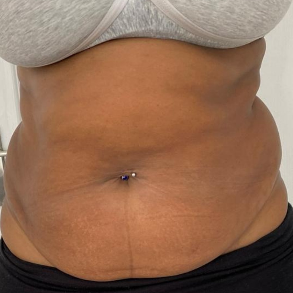 Fat Freeze · Abdomen, before treatment at Saint Aesthetics Clinic in Fourways, Sandton
