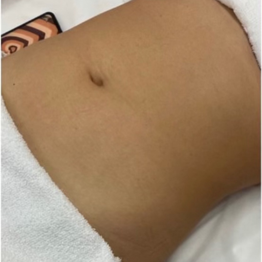 Body Contouring · Abdomen, before treatment at Saint Aesthetics Clinic in Fourways, Sandton