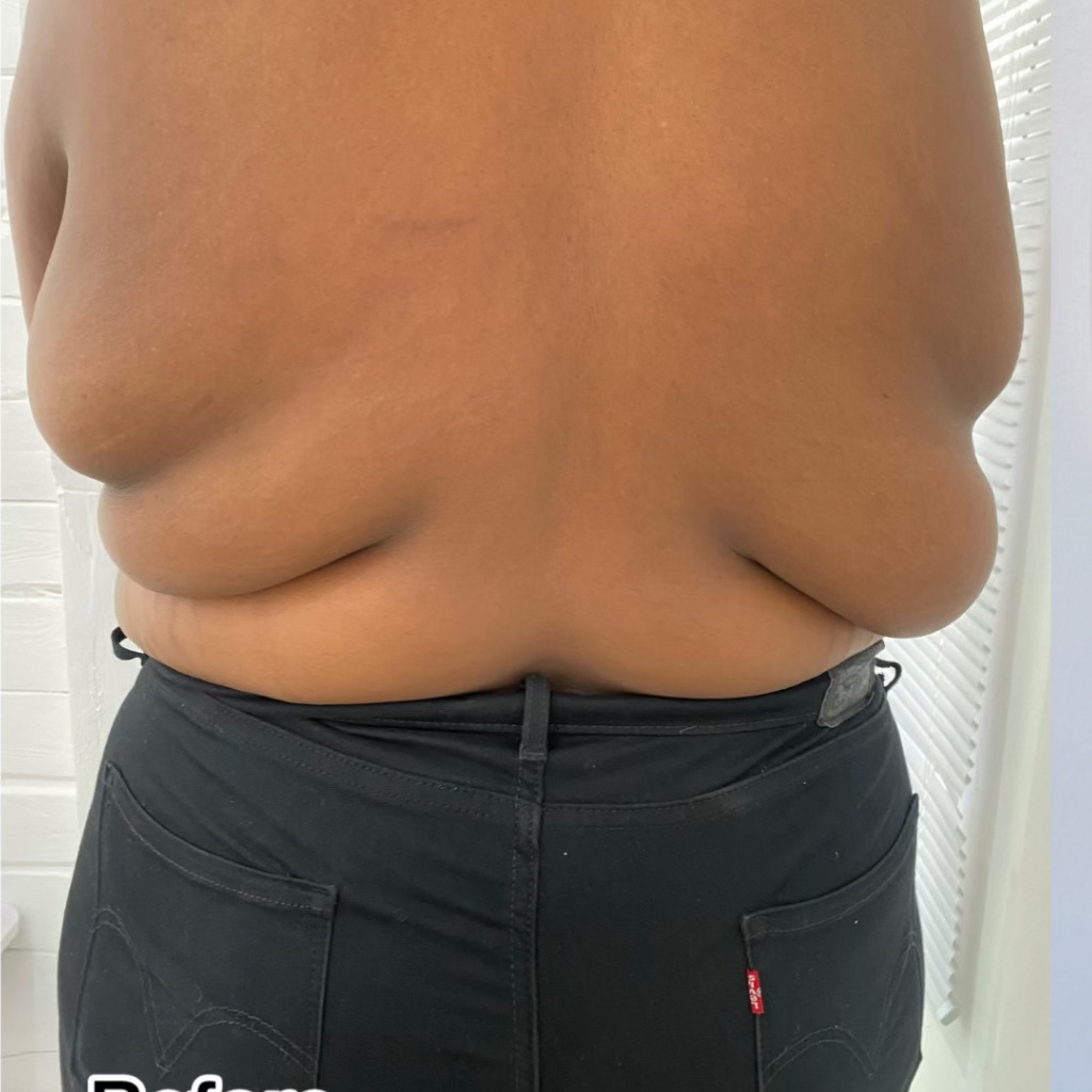 Body Contouring · Back, before treatment at Saint Aesthetics Clinic in Fourways, Sandton