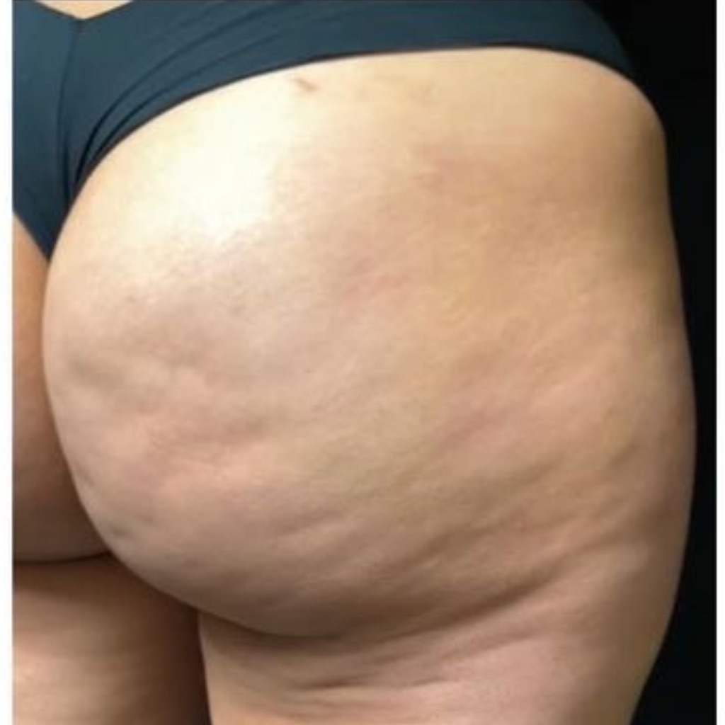 Cellulite · Bum, before treatment at Saint Aesthetics Clinic in Fourways, Sandton