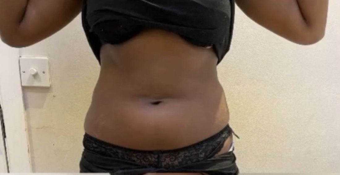 Lipo Slimming Injections Special, before treatment at Saint Aesthetics Clinic in Fourways, Sandton
