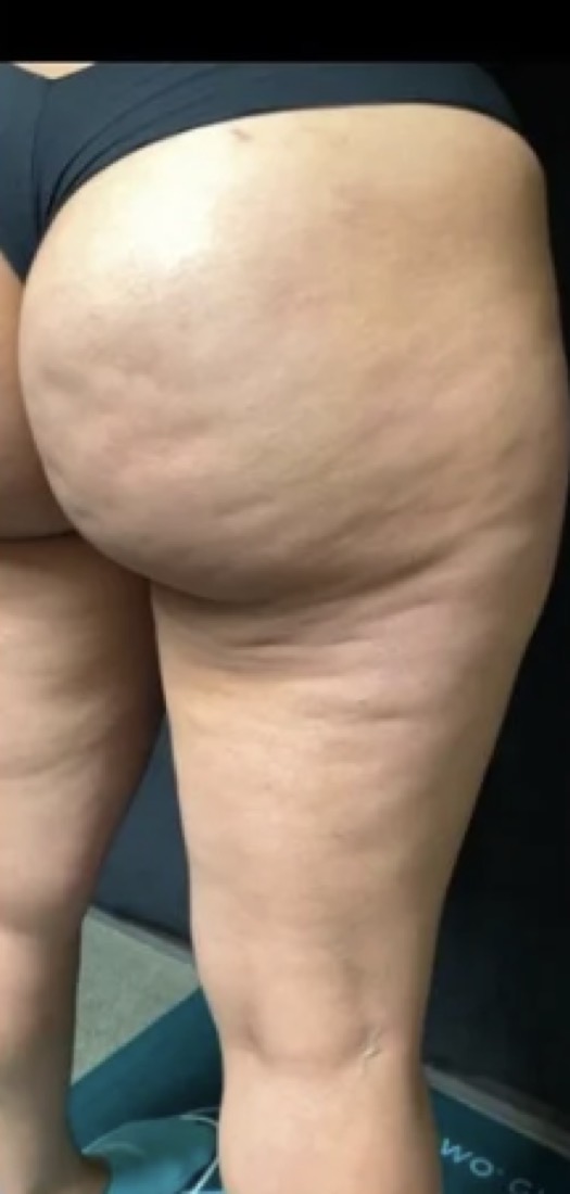 Cavitation, before treatment at Saint Aesthetics Clinic in Fourways, Sandton