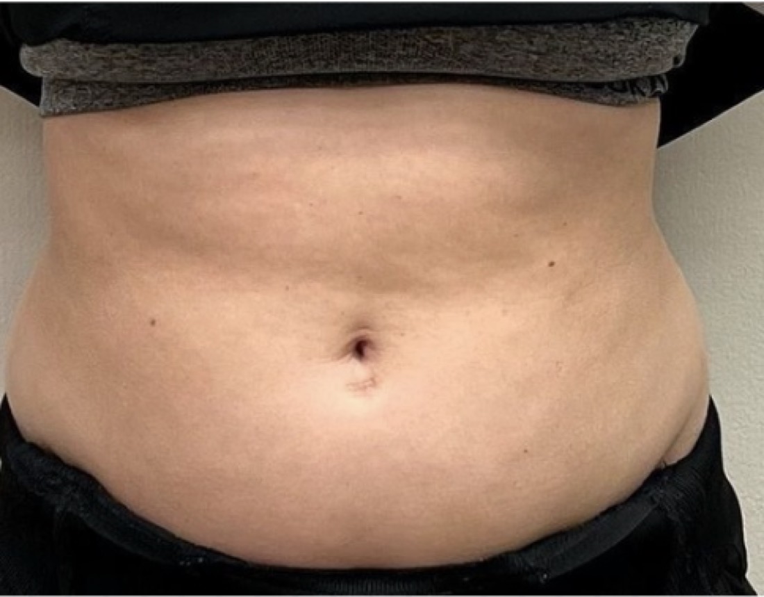 Package 4, after treatment at Saint Aesthetics Clinic in Fourways, Sandton