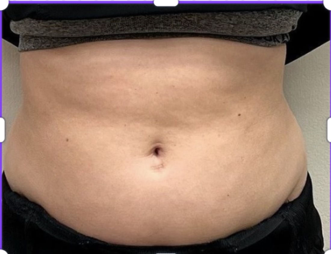 Package 4, before treatment at Saint Aesthetics Clinic in Fourways, Sandton
