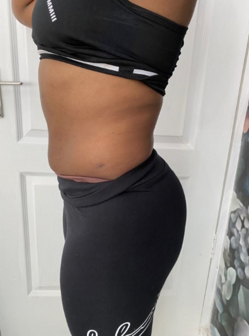 Fat Freeze (sessions only), after treatment at Saint Aesthetics Clinic in Fourways, Sandton