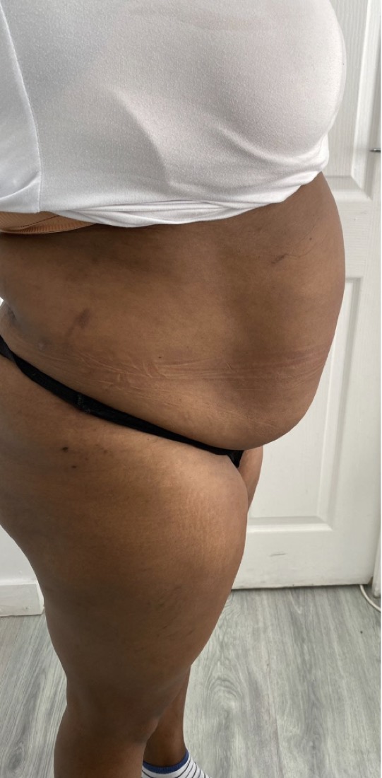 Fat Freeze (sessions only), before treatment at Saint Aesthetics Clinic in Fourways, Sandton